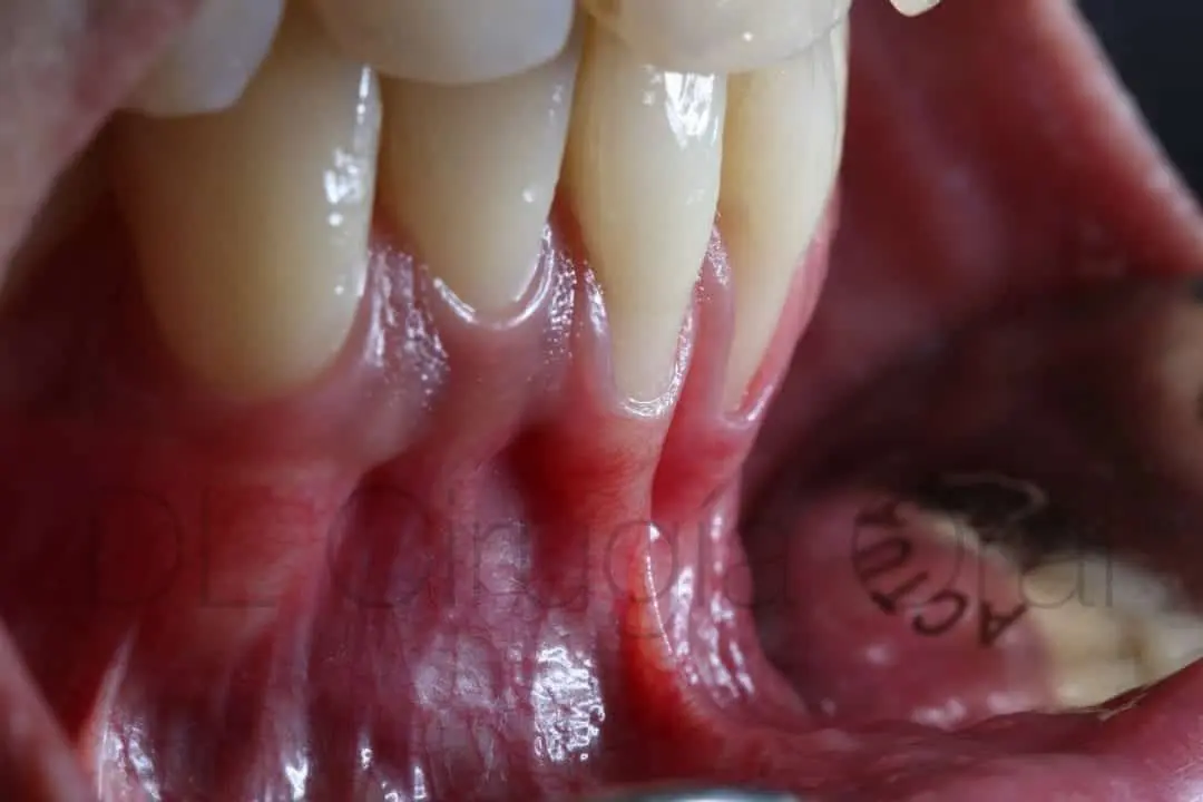 A lower front sextant with gingival recession, before grafting
