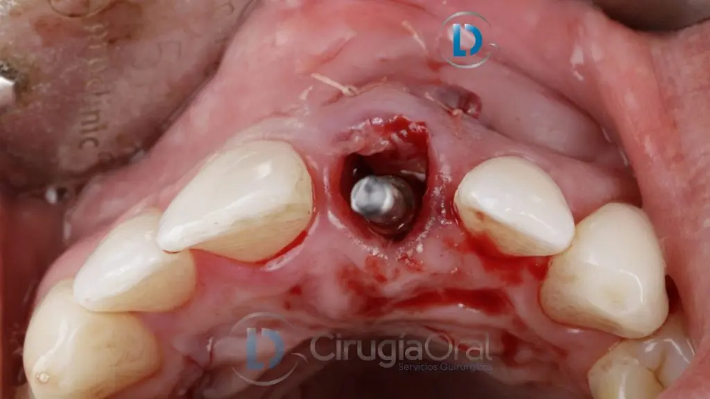An implant placed in the socket of an upper incisor immediately after the extraction