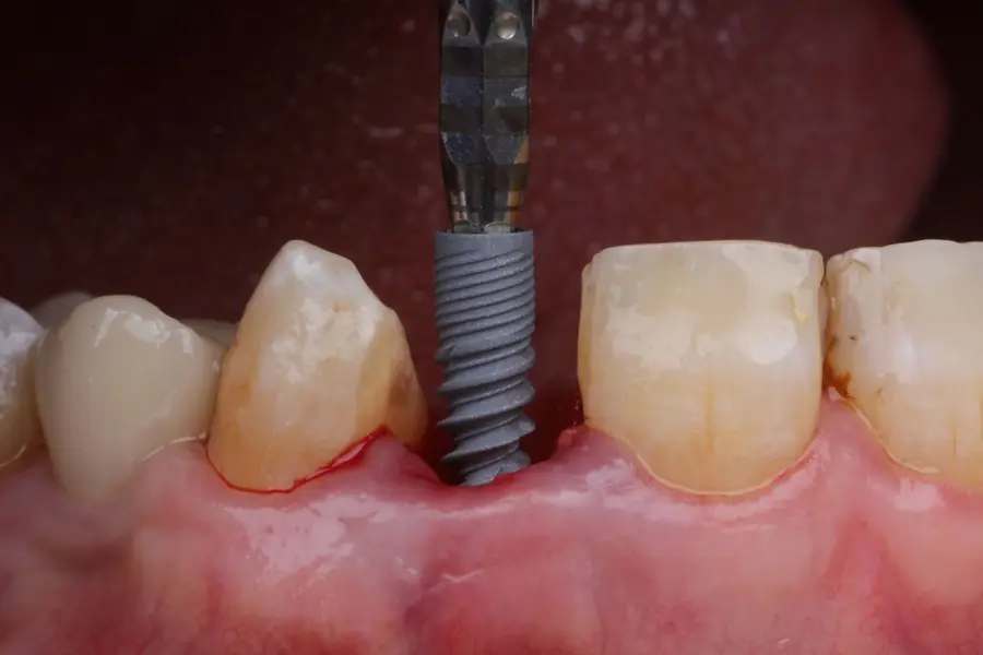 An implant placed in the upper anterior, seen with the gum retracted