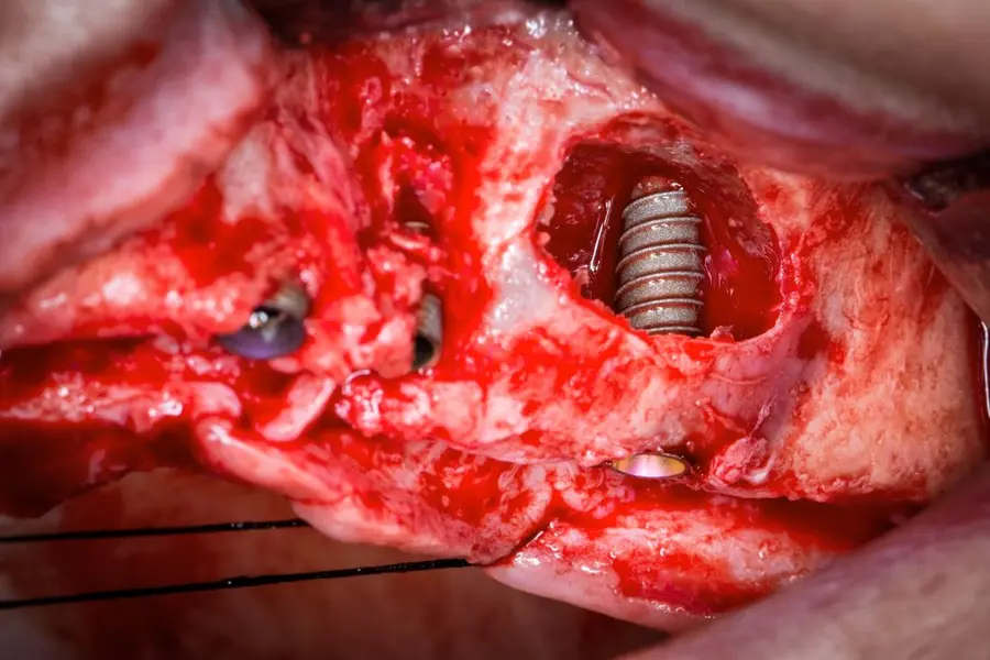 A bone graft fixed with screws over the defect, next to the implant, through the open flap