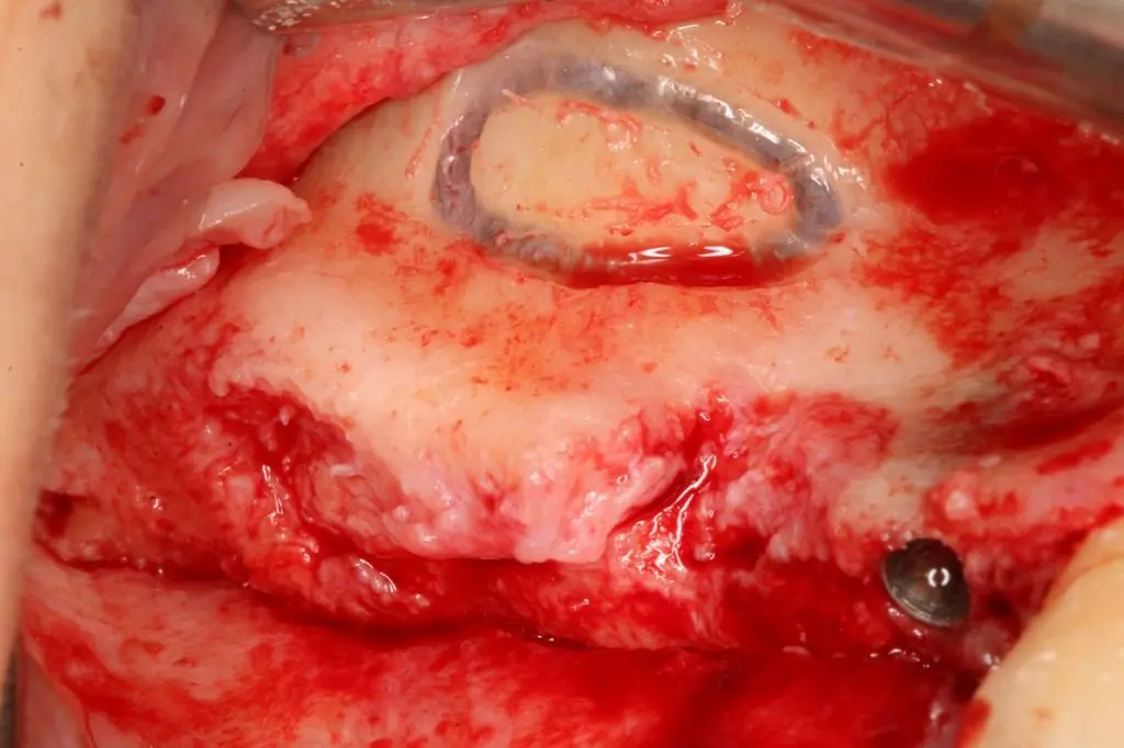 A lateral window opened in the maxillary sinus, with the membrane lifted
